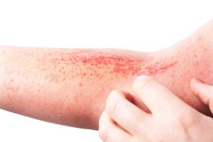 Dermatite sul braccio